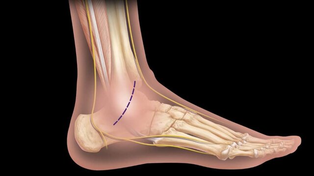 Ankle Sprains (Lateral Ankle Instability): Treatment Options, video thumbnail