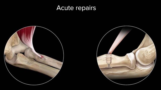 Distal Biceps Tendon Tears: Treatment Options, video thumbnail