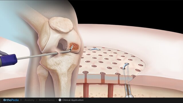 Knee Cartilage Defects: General Surgical Considerations, video thumbnail
