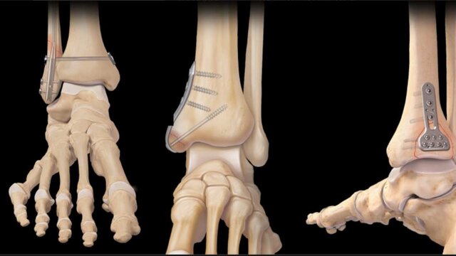 Ankle Fractures: Treatment Options, video thumbnail