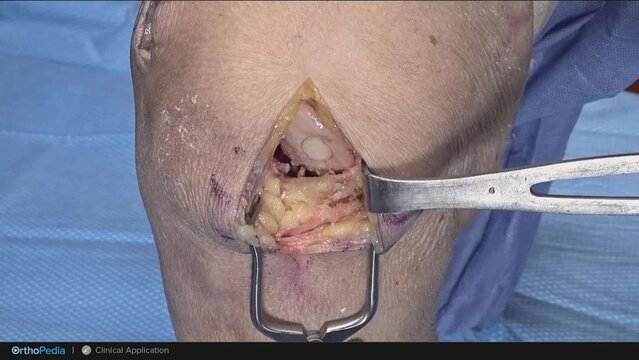 Knee Cartilage Defects: Autograft OATS® 2.0 Procedure, video thumbnail