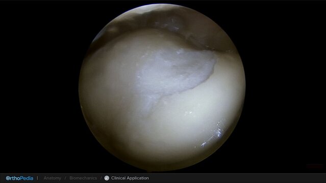 Knee Cartilage Defects: BioCartilage® Extracellular Matrix Allograft for Trochlear Defects, video thumbnail