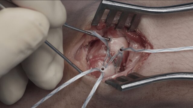 Scapholunate Ligament Injuries: Anatomic C Scapholunate Ligament Reconstruction With the InternalBrace Ligament Augmentation Technique, video thumbnail