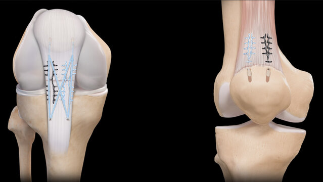 Patellar and Quadriceps Tendon Tears: Treatment Options, video thumbnail