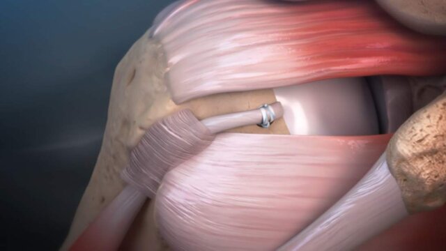 Biceps Tendinitis: Arthroscopic Repair Technique at the Top of the Groove, video thumbnail