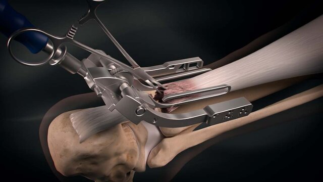 Achilles Tendon Tears: Midsubstance Achilles Tendon Repair, video thumbnail