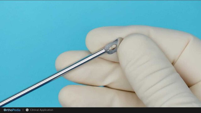 Knee Cartilage Defects: Particulated Osteochondral Autograft Procedure for Condylar Defects, video thumbnail