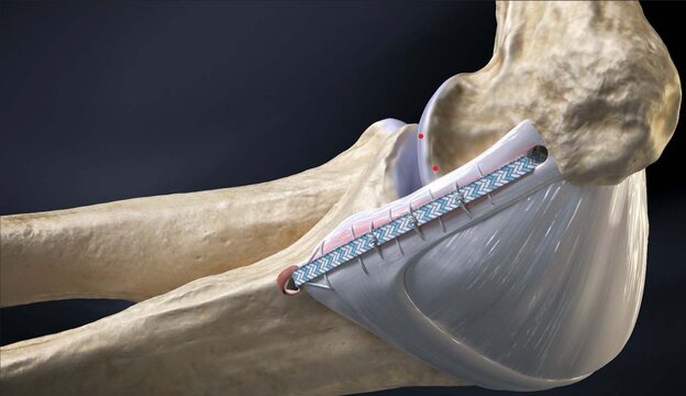 UCL Injuries (Tommy John): Ligament Repair With Suture Augmentation Procedure, video thumbnail