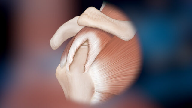 Rotator Cuff Tears: When Is Rotator Cuff Augmentation Needed?, video thumbnail