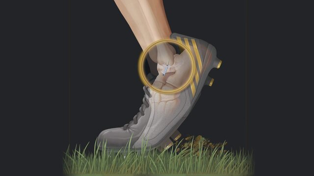 Ankle Sprains (Lateral Ankle Instability): Why Do They Keep Happening?, video thumbnail