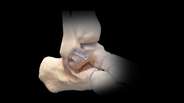 Ankle Sprains (Lateral Ankle Instability): Broström Repair With Suture Augmentation, video thumbnail
