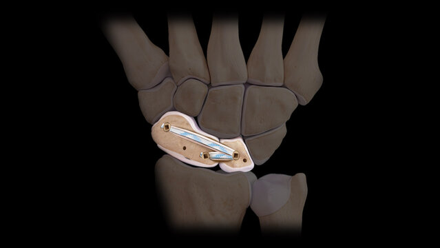 Scapholunate Ligament Injuries: Treatment Options, video thumbnail