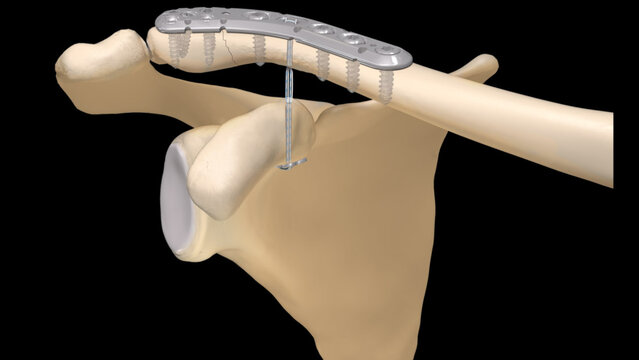 Clavicle Fractures: Open Reduction Internal Fixation With a Plate and Suture Implant, video thumbnail
