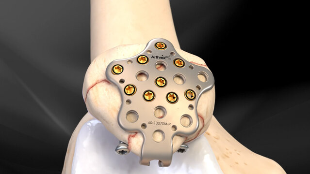 Kneecap (Patella) Fractures: Fixation With a Plate and Screws, video thumbnail