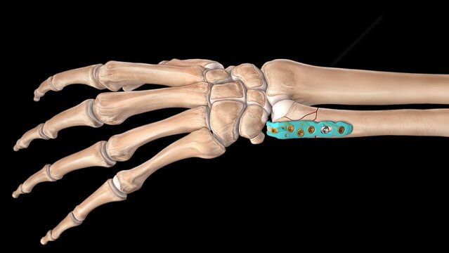 Wrist Fractures: Fixation With Ulnar Styloid Plating, video thumbnail