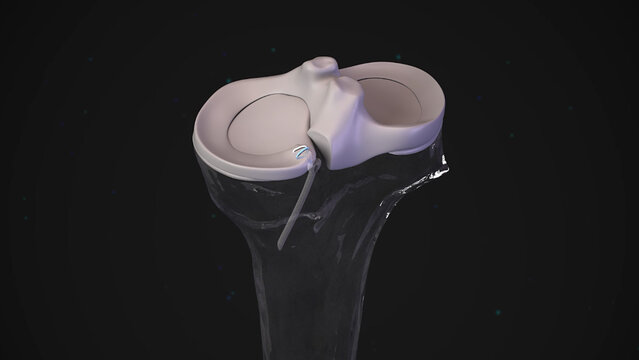 Meniscus Tears: Meniscal Root Repair, video thumbnail