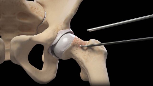 Hip Impingement (FAI) and Labral Tears: Treatment Options, video thumbnail
