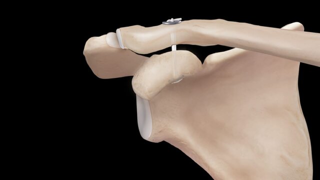 Shoulder Separation (AC Joint): Treatment Options, video thumbnail