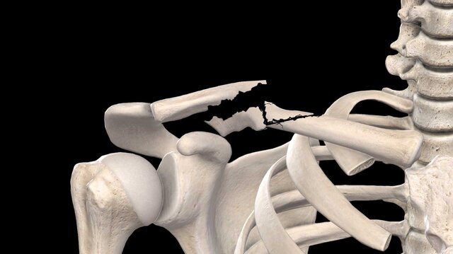 Clavicle Fractures: Overview, video thumbnail