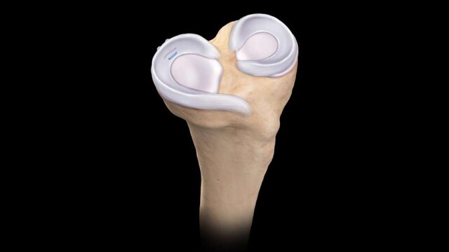 Meniscus Tears: All-Inside Meniscus Repair, video thumbnail