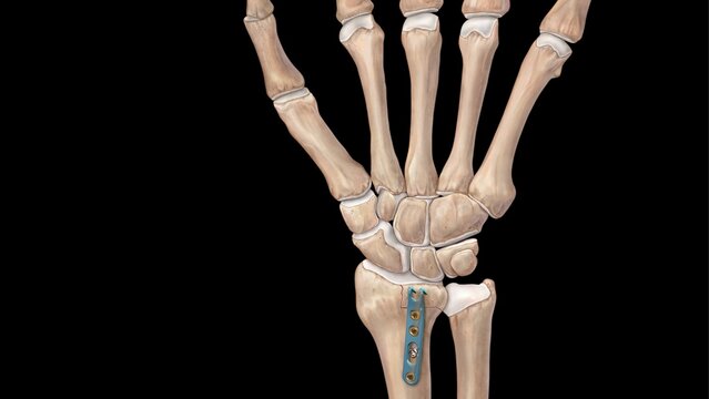 Wrist Fractures: Fixation With a Wrist Hook Plate, video thumbnail
