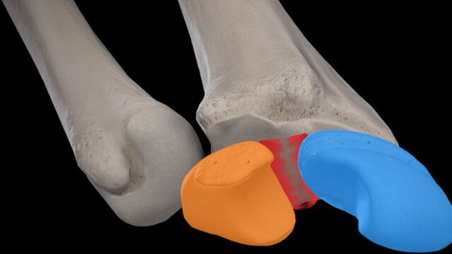 Scapholunate Ligament Injuries: Overview, video thumbnail