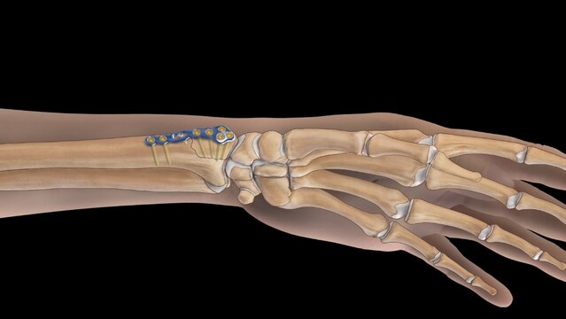 Wrist Fractures: Fixation of Radial Styloid Process Fractures With a Plate, video thumbnail