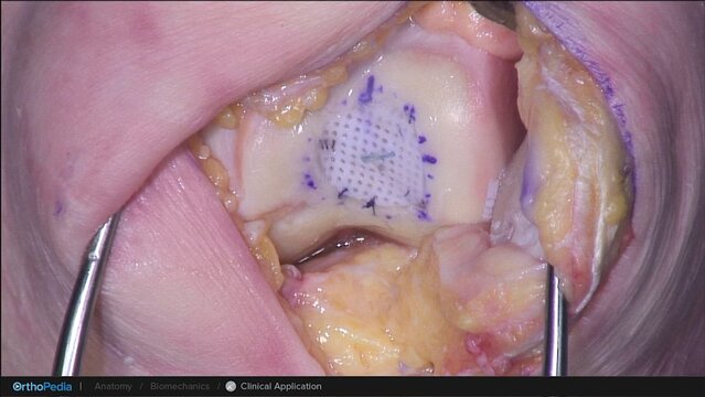 Knee Cartilage Defects: Cartiform® Viable Osteochondral Allograft Procedure for Trochlear Defects, video thumbnail