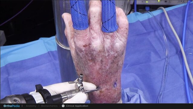 TFCC Tears: Open Foveal Repair, video thumbnail