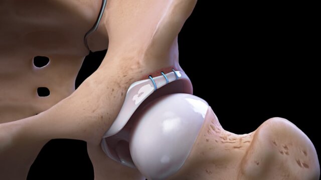 Hip Impingement (FAI) and Labral Tears: Repair of Hip Labral Tear Using Soft Anchors, video thumbnail
