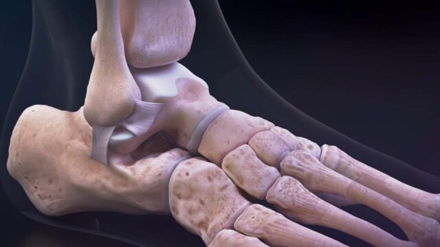 Ankle Sprains (Lateral Ankle Instability): Overview, video thumbnail