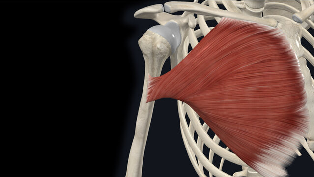 Pectoralis Major Tendon Tears: Overview, video thumbnail