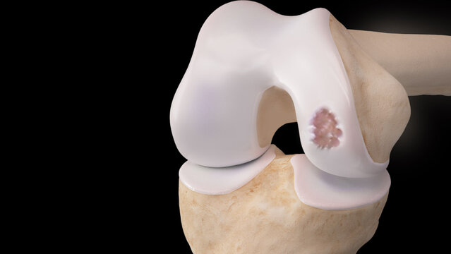 Knee Cartilage Defects: Overview, video thumbnail