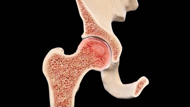 Hip Avascular Necrosis (AVN): Overview, video thumbnail