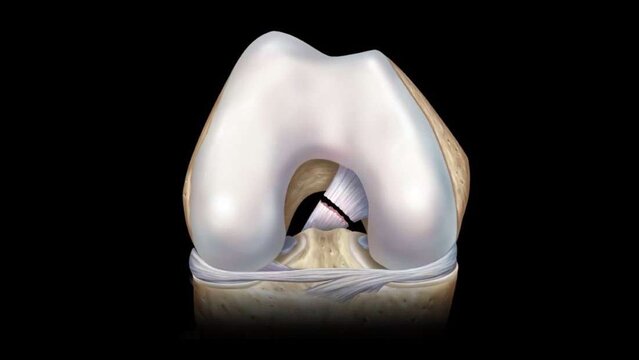 PCL Tears: Treatment Options, video thumbnail