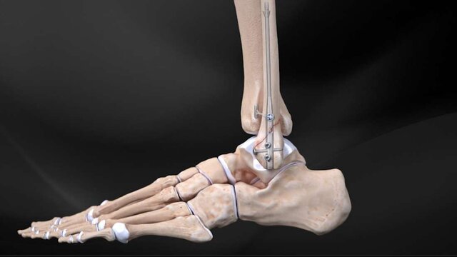 Ankle Fractures: Fixing the Fracture With a Bone Nail and Screws, video thumbnail