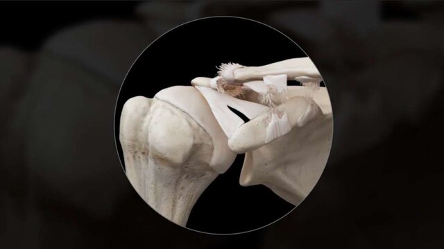 Shoulder Separation (AC Joint): Overview, video thumbnail