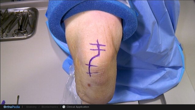 Distal Triceps Tendon Tears: Distal Triceps Repair With Knotless SwiveLock® Anchor, video thumbnail