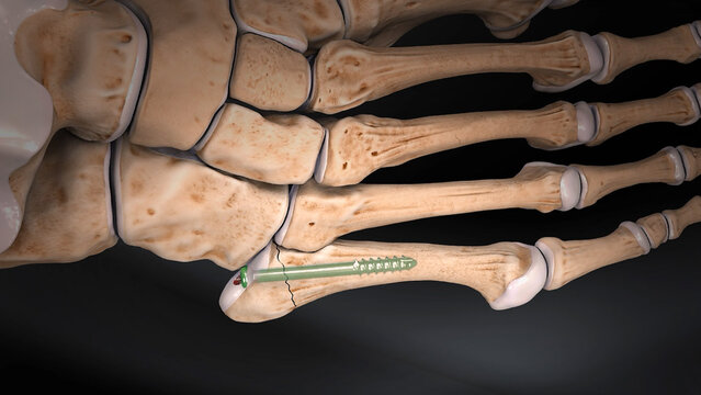 Fifth Metatarsal (Jones) Fractures: Screw Fixation With a Jones Screw, video thumbnail