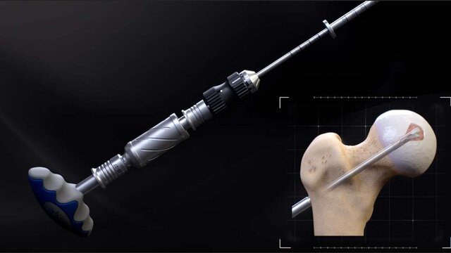 Hip Avascular Necrosis (AVN): AVN Treatment With an Expandable Reamer, video thumbnail