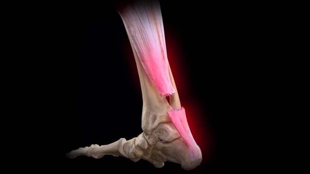 Achilles Tendon Tears: Treatment Options, video thumbnail
