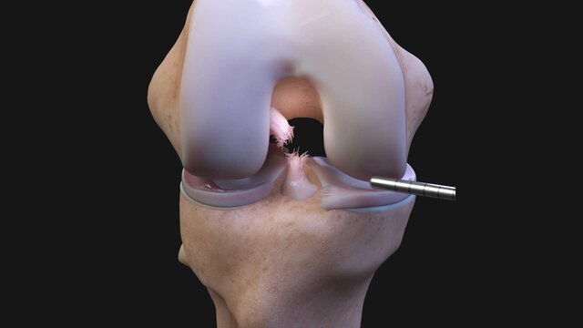 ACL Tears: Understanding ACL Tears, video thumbnail