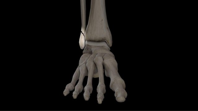 Ankle Fractures: Overview, video thumbnail
