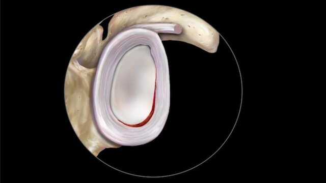 Shoulder Instability: Treatment Options, video thumbnail