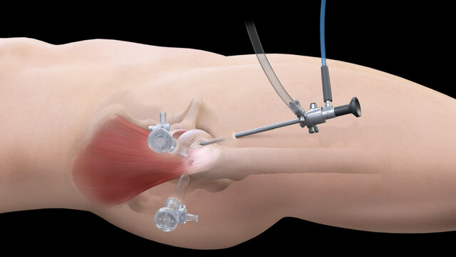 Gluteus Medius Tears: Treatment Options, video thumbnail