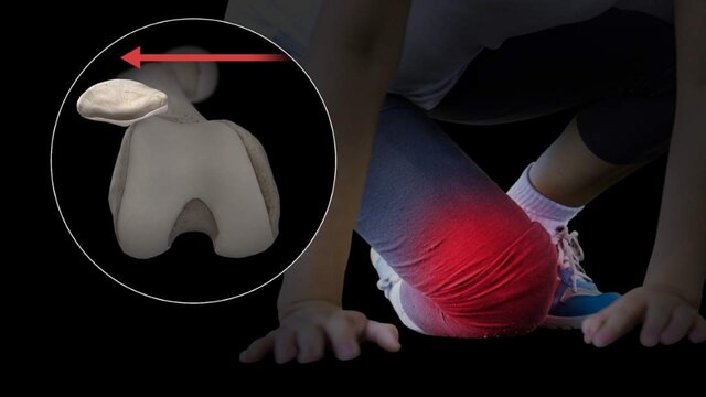 Kneecap (Patellar) Instability: Treatment Options, video thumbnail