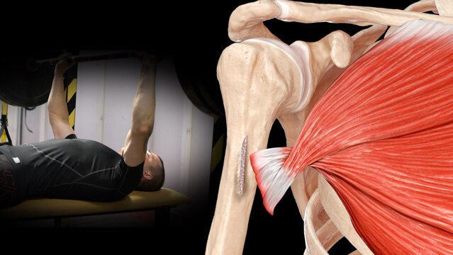 Pectoralis Major Tendon Tears: Treatment Options, video thumbnail