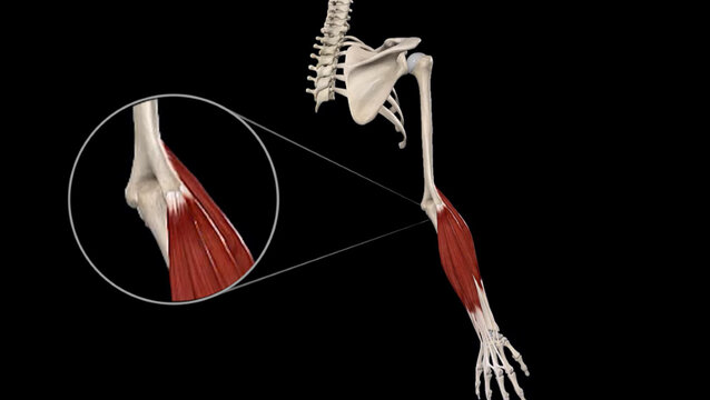 Tennis Elbow (Lateral Epicondylitis): Overview, video thumbnail