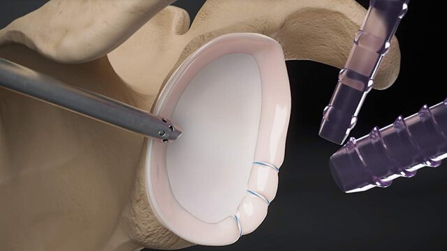 Shoulder Instability: Labral Repair Using Knotless Soft Anchors, video thumbnail