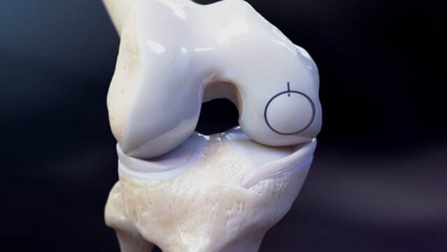 Knee Cartilage Defects: Medium Cartilage Defect Replacement, video thumbnail